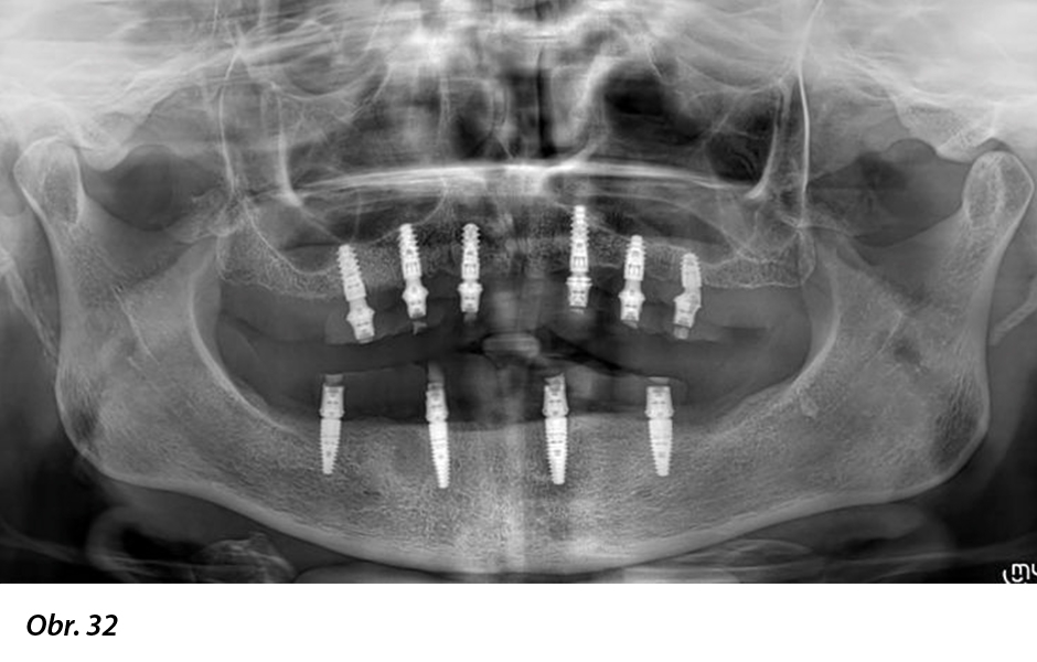 Digitálně zhotovená okamžitá celková fixní náhrada nesená implantáty Straumann® BLX ø 3,75, krátkými distálními implantáty