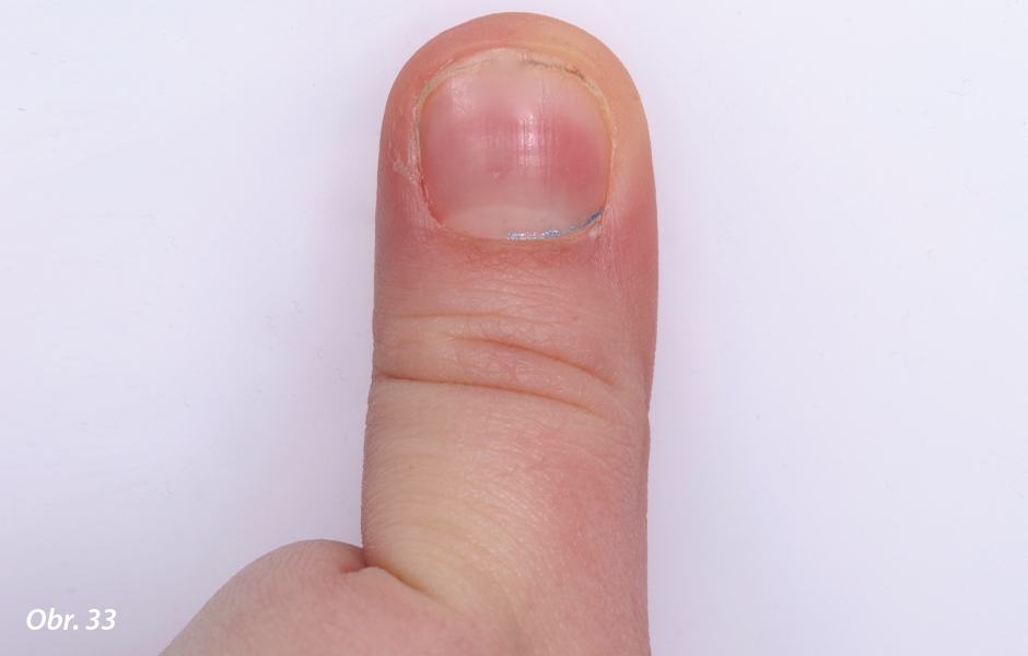 Obr. 33: Obrázek pacientova prstu demonstrující zlozvyk. 