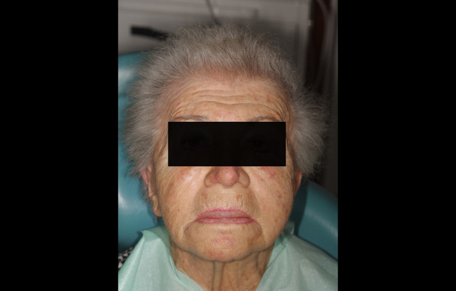 Obr. 1a: Extraorální pohled na obličej pacientky bez úsměvu.