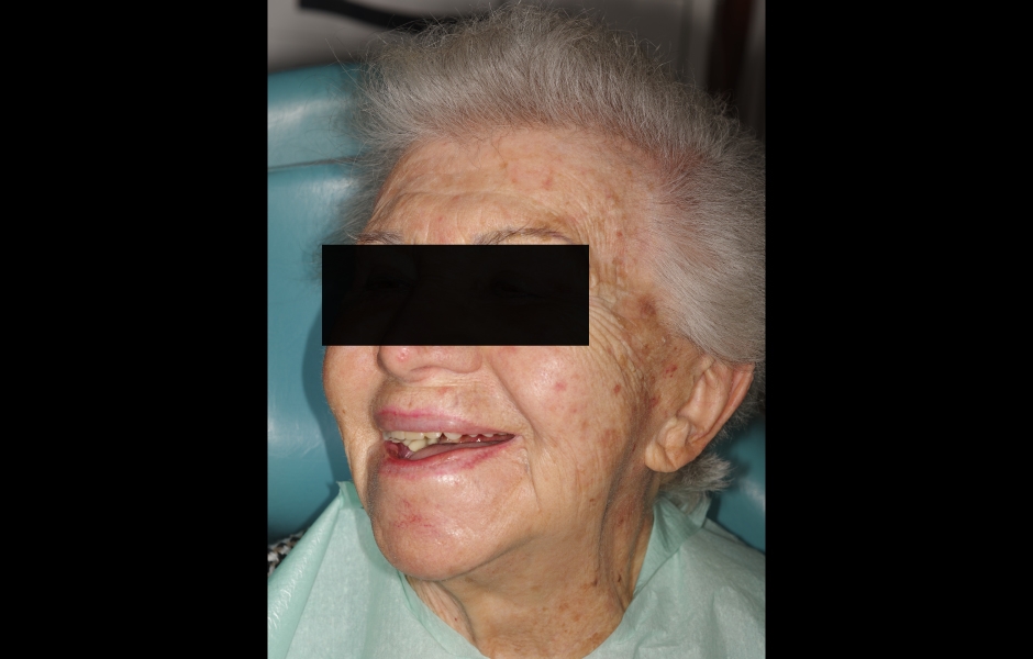 Obr. 2a: Extraorální pohled na pacientku s úsměvem – všimněte si odchylky horní středové linie.