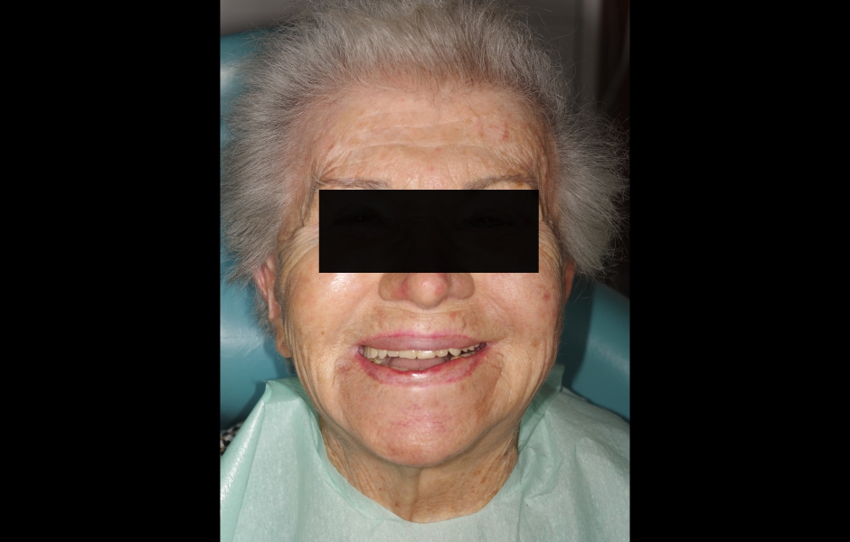 Obr. 2b: Extraorální pohled na pacientku s úsměvem – všimněte si odchylky horní středové linie.