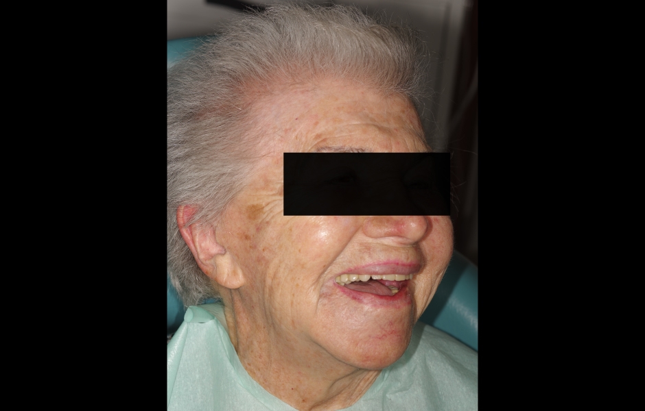 Obr. 2c: Extraorální pohled na pacientku s úsměvem – všimněte si odchylky horní středové linie.