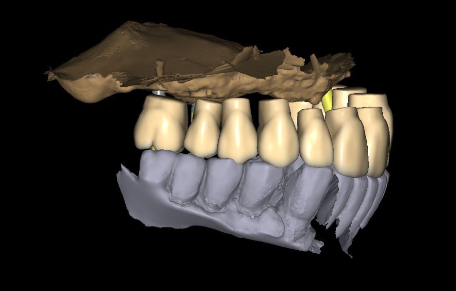 Obr. 10a: Virtuální navrhování zubního oblouku budoucí hybridní náhrady.