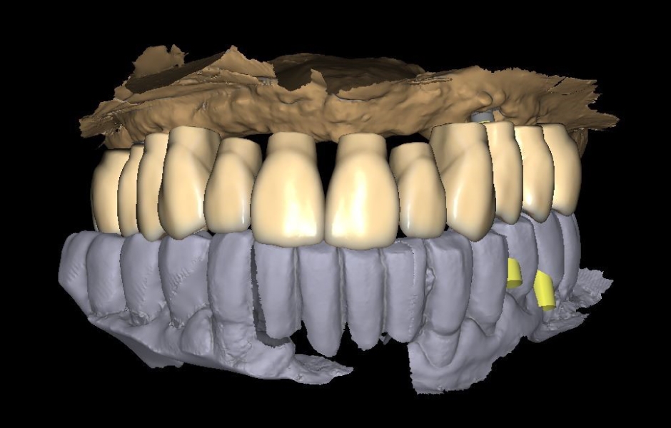 Obr. 10b: Virtuální navrhování zubního oblouku budoucí hybridní náhrady.