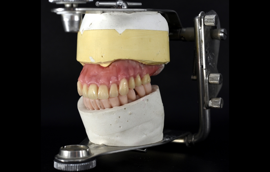 Obr. 11a: Model horní náhrady z vosku a konfekčních zubů v artikulátoru.