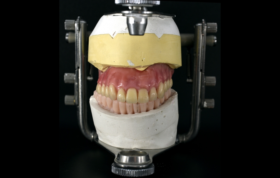 Obr. 11b: Model horní náhrady z vosku a konfekčních zubů v artikulátoru.