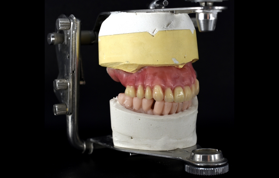 Obr. 11c: Model horní náhrady z vosku a konfekčních zubů v artikulátoru.
