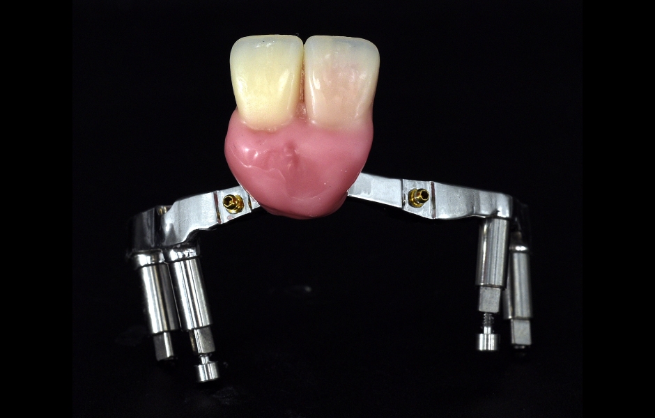 Obr. 15b: Třmen s kontrolním umístěním řezáků – všimněte si vzdálenosti mezi třmenem a zuby.