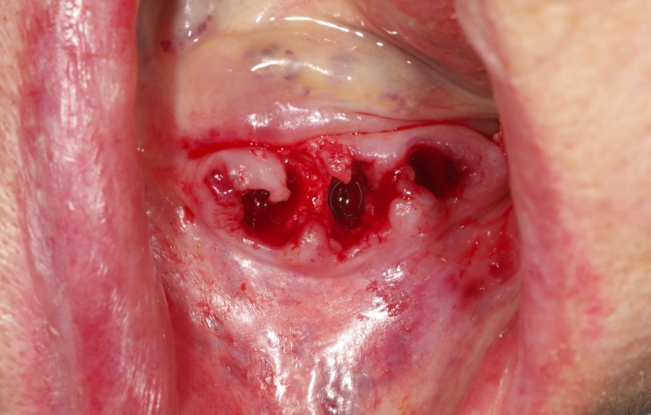 Obr. 21a: Extrakce zbylých zubů v dolní čelisti a zavedení implantátu do oblasti zubu 33. Zevrubný popis protetického ošetření dolní čelisti není předmětem tohoto sdělení.