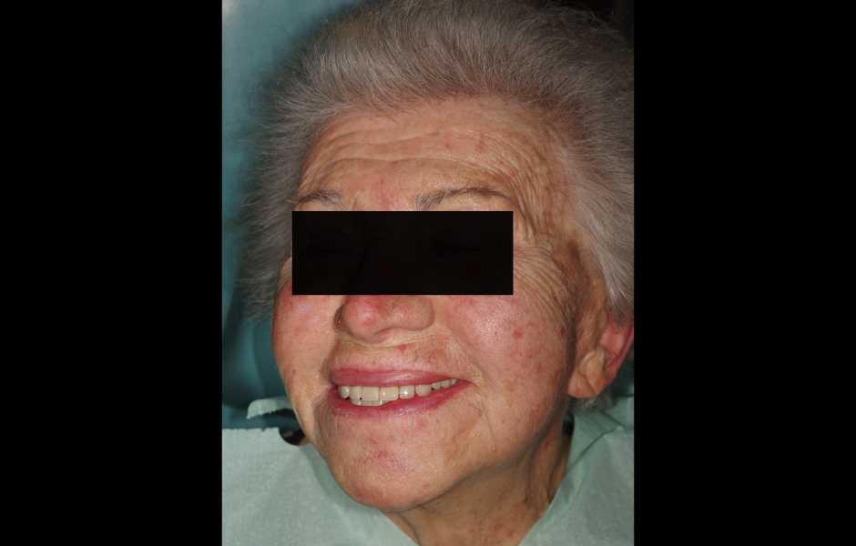 Obr. 22a: Pacientka s úsměvem po celkovém protetickém pošetření. Všimněte si korekce odchylky horní středové linie.