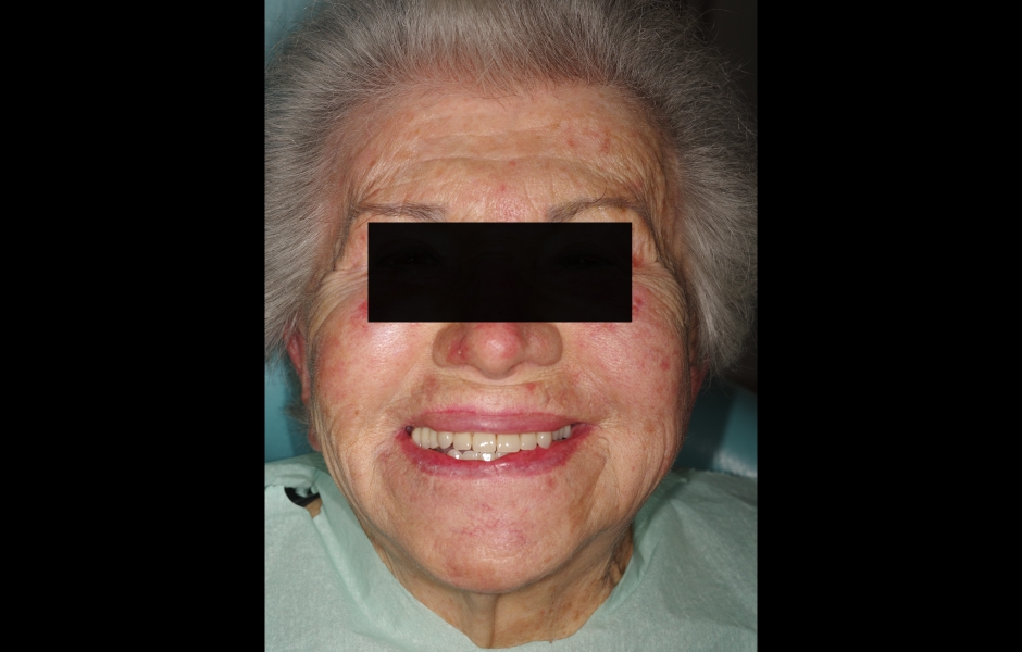 Obr. 22b: Pacientka s úsměvem po celkovém protetickém pošetření. Všimněte si korekce odchylky horní středové linie.