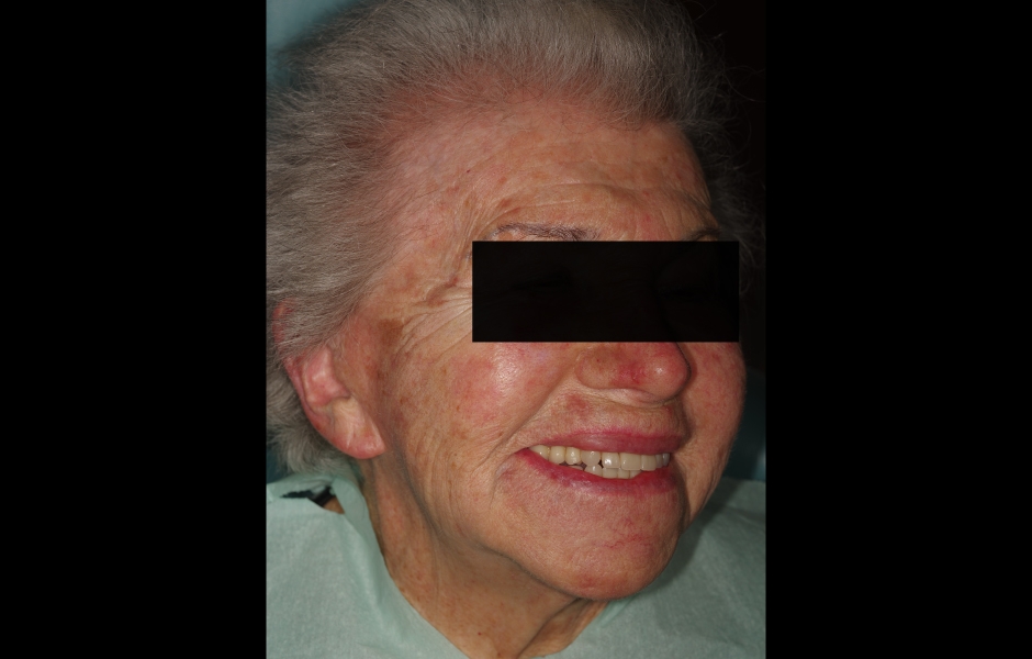 Obr. 22c: Pacientka s úsměvem po celkovém protetickém pošetření. Všimněte si korekce odchylky horní středové linie.