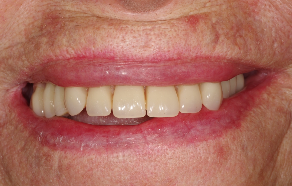 Obr. 24: Detail úsměvu pacientky po ošetření.