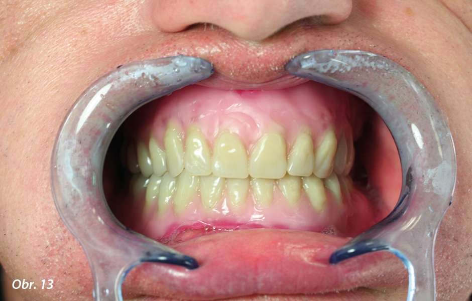 První zkouška zubů ve vosku