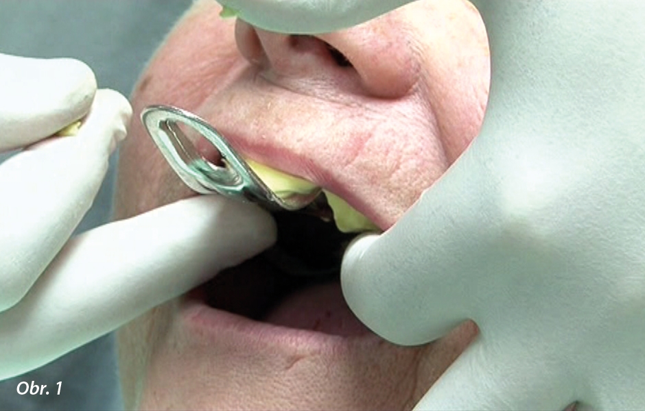 Standardní sejmutí primárního otisku protézního lože pacienta pomocí konfekční lžičky a alginátové otiskovací hmoty v zubní ordinaci