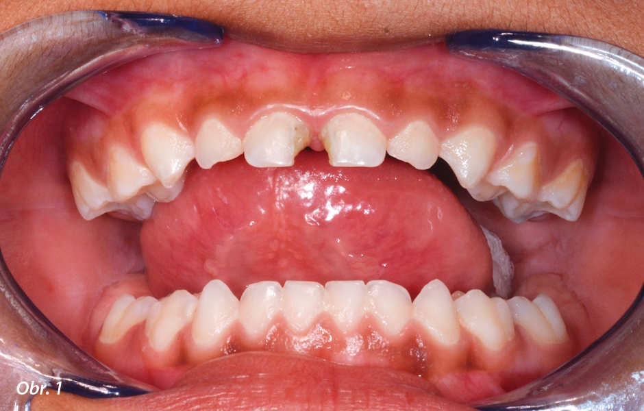 Pulpotomie u frontálních zubů: Lokální anestezie 