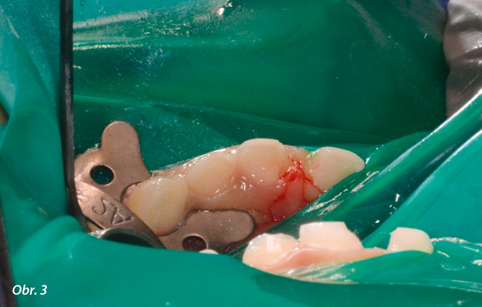 Pulpotomie u frontálních zubů: Odstranění kazu