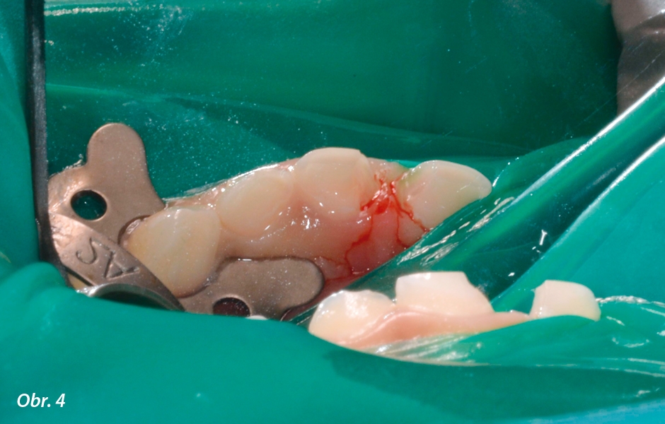 Pulpotomie u frontálních zubů: Pulpotomie po úroveň cementosklovinného spojení