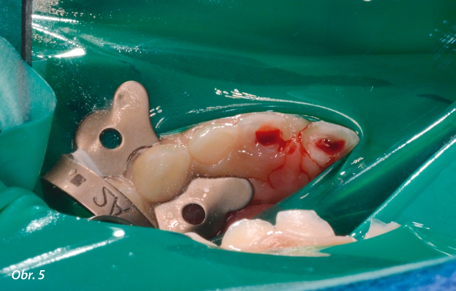 Pulpotomie u frontálních zubů: Dezinfekce 6% NaOCl
