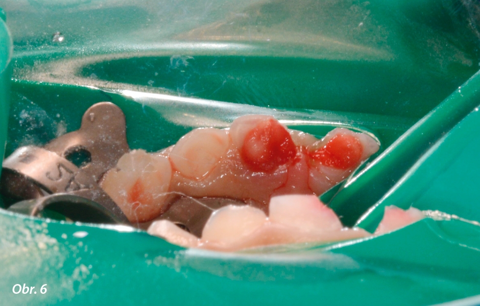 Pulpotomie u frontálních zubů: Nanášení Biodentine™