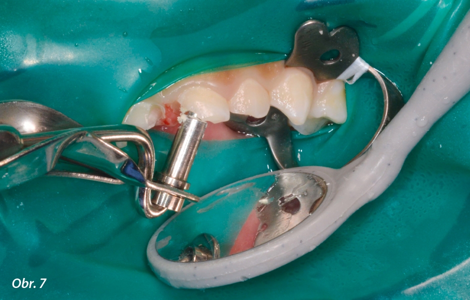 Pulpotomie u frontálních zubů: Skloionomerní nebo IRM podložka (volitelná – použije-li se Biodentine™ podložka není nutná)