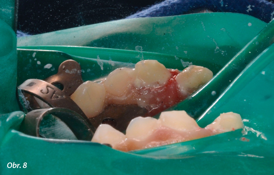 Pulpotomie u frontálních zubů: Biodentine™ nebo skloionomerní (IRM podložka se nechá vytvrdit)
