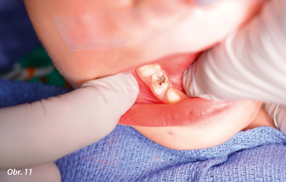 Pulpotomie u distálních zubů: Lokální anestezie