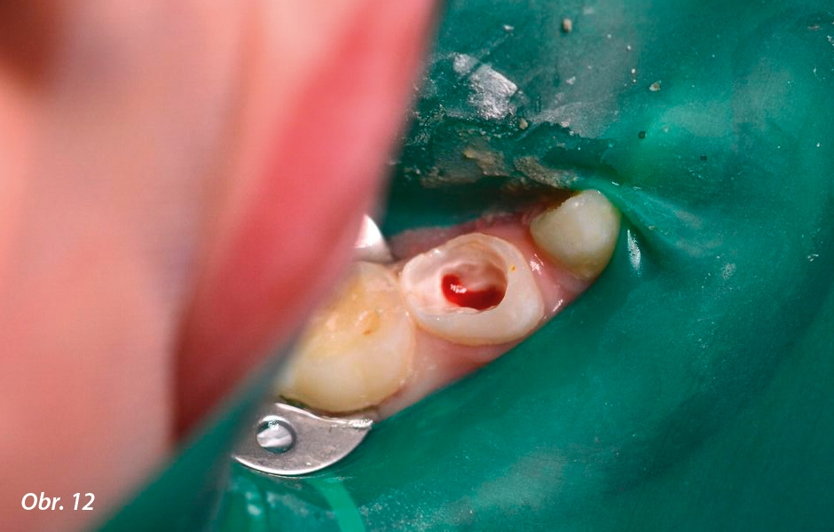 Pulpotomie u distálních zubů: Izolace kofferdamem, odstranění kazu
