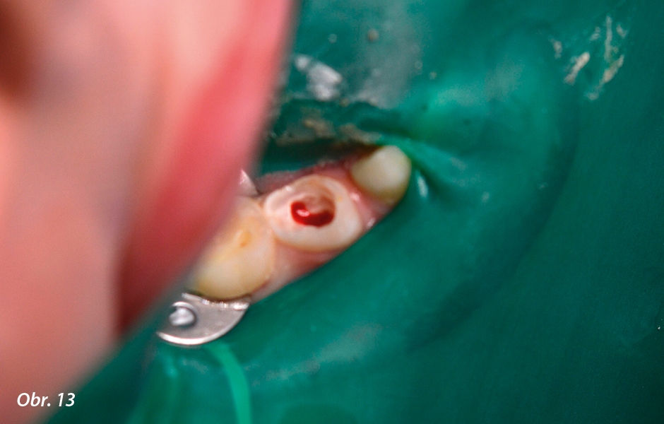 Pulpotomie u distálních zubů: Pulpotomie po úroveň cementosklovinného spojení