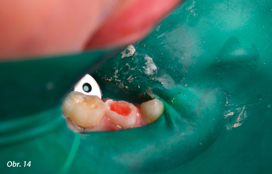 Pulpotomie u distálních zubů: Dezinfekce 6% NaOCl