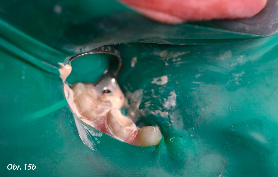 Pulpotomie u distálních zubů: Nanášení Biodentine™