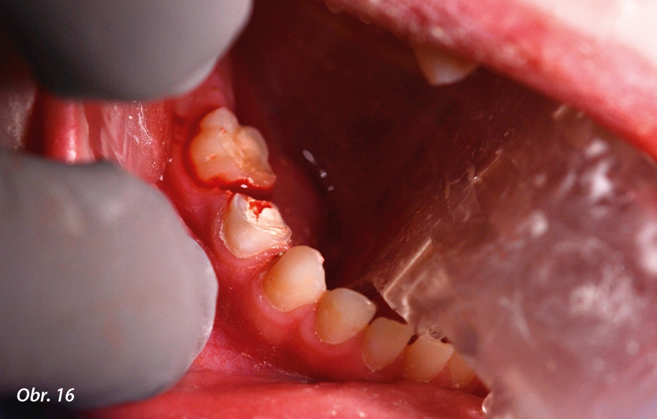 Pulpotomie u distálních zubů: Preparace pro nerezovou korunku