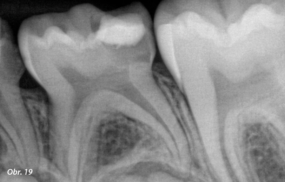Pooperační vyhodnocování pulpotomií: Kontrola pulpotomií s použitím Biodentine™ po jednom roce u zubů 55, 65, 75 a 85 neukazuje žádné známky furkačních nebo apikálních patologií