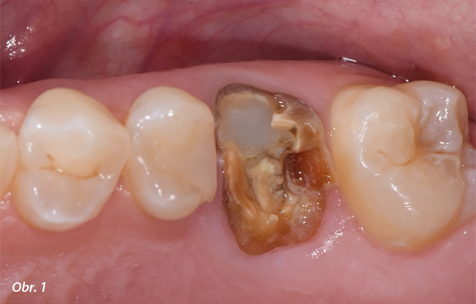 Straumann® TLX implantát a okamžitá náhrada jednoho moláru v horní čelisti