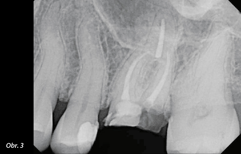 Straumann® TLX implantát a okamžitá náhrada jednoho moláru v horní čelisti