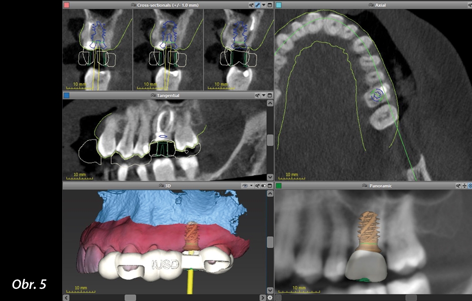 Straumann® TLX implantát a okamžitá náhrada jednoho moláru v horní čelisti