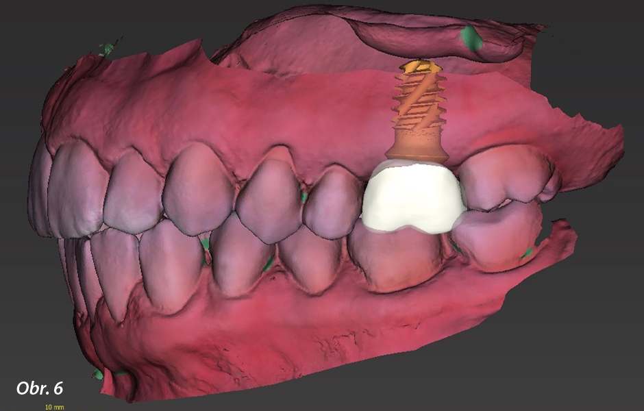 Straumann® TLX implantát a okamžitá náhrada jednoho moláru v horní čelisti