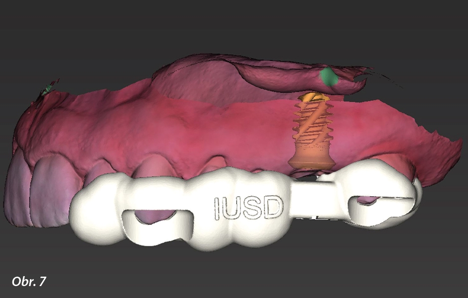 Straumann® TLX implantát a okamžitá náhrada jednoho moláru v horní čelisti