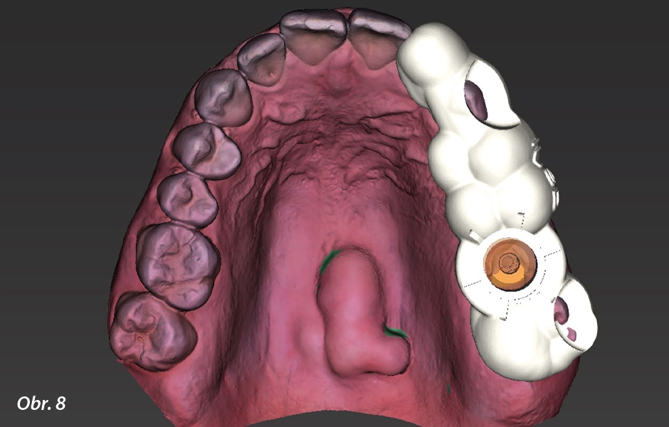 Straumann® TLX implantát a okamžitá náhrada jednoho moláru v horní čelisti