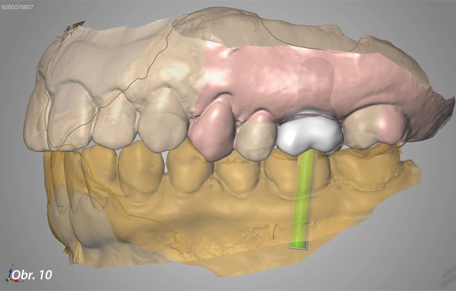 Straumann® TLX implantát a okamžitá náhrada jednoho moláru v horní čelisti