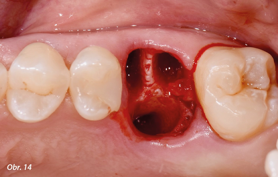 Straumann® TLX implantát a okamžitá náhrada jednoho moláru v horní čelisti