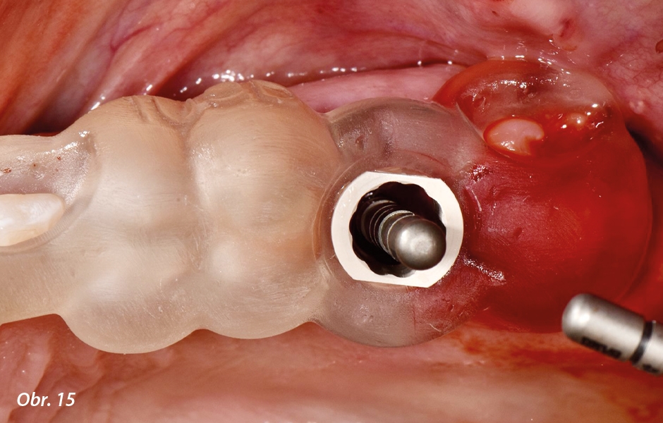 Straumann® TLX implantát a okamžitá náhrada jednoho moláru v horní čelisti