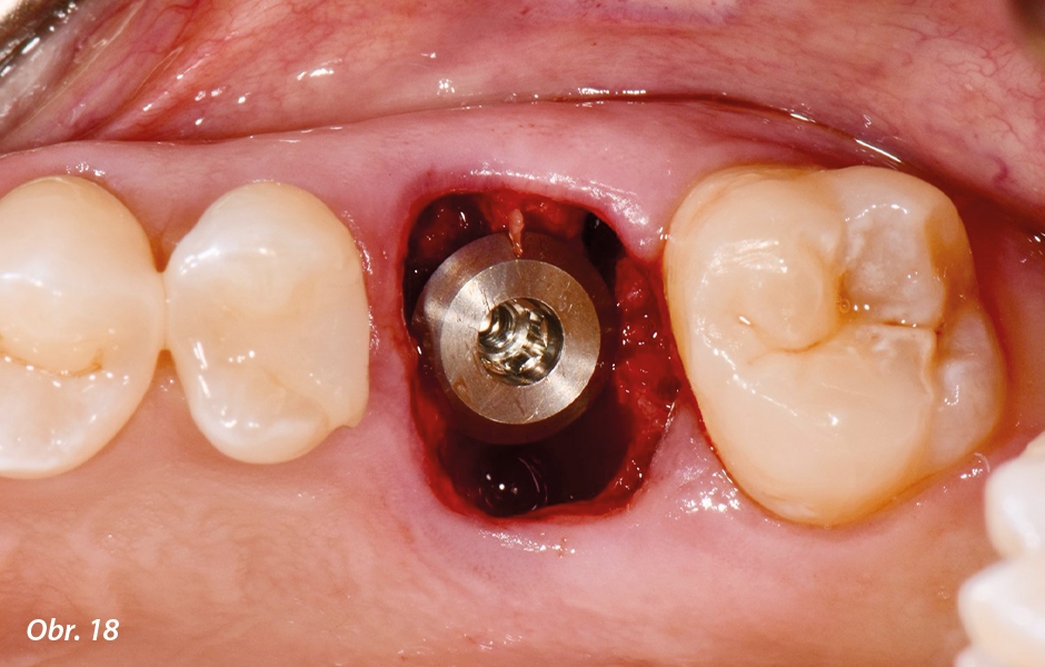 Straumann® TLX implantát a okamžitá náhrada jednoho moláru v horní čelisti