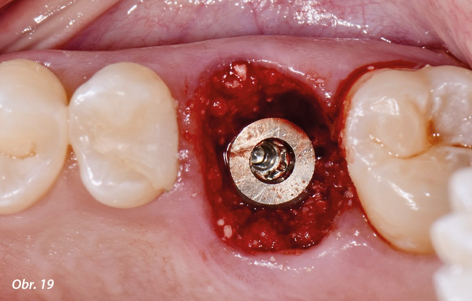 Straumann® TLX implantát a okamžitá náhrada jednoho moláru v horní čelisti