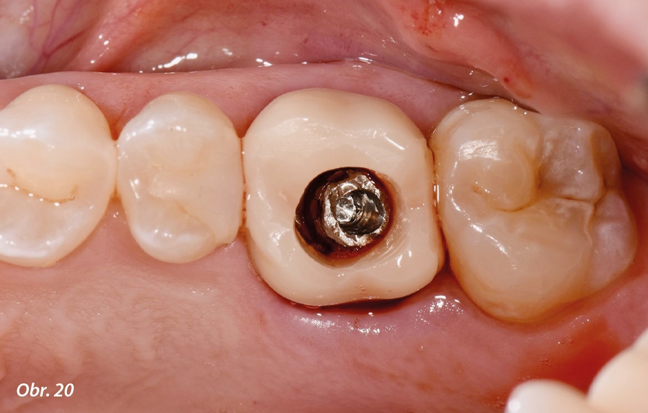 Straumann® TLX implantát a okamžitá náhrada jednoho moláru v horní čelisti