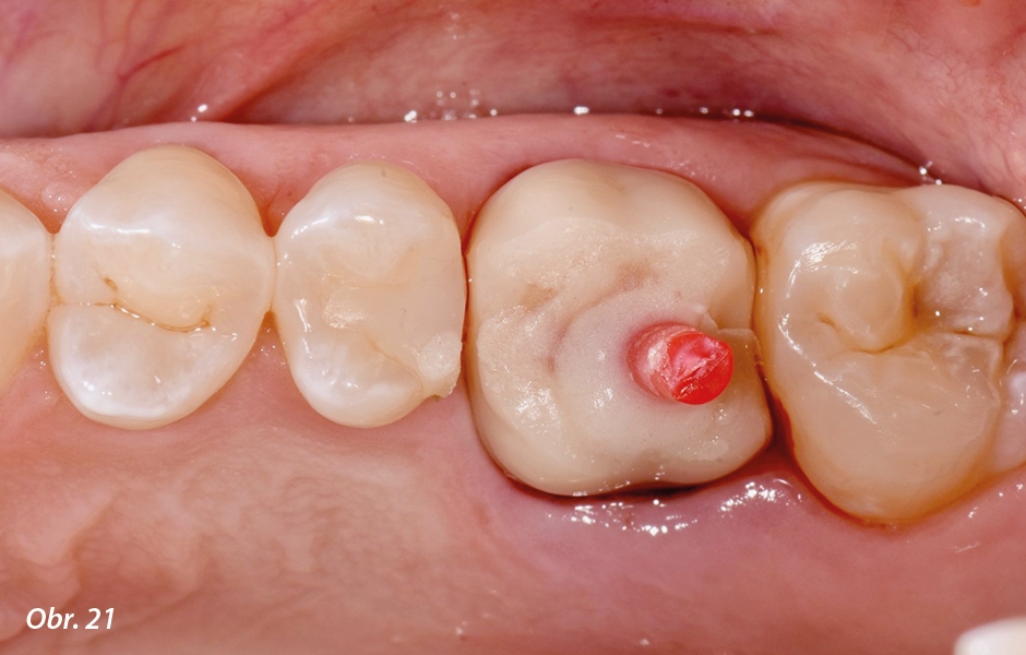 Straumann® TLX implantát a okamžitá náhrada jednoho moláru v horní čelisti