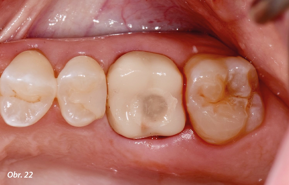 Straumann® TLX implantát a okamžitá náhrada jednoho moláru v horní čelisti