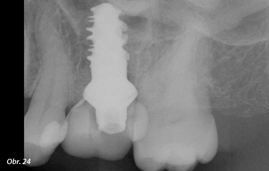 Straumann® TLX implantát a okamžitá náhrada jednoho moláru v horní čelisti