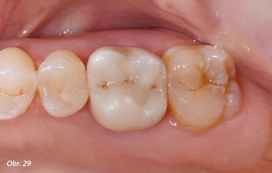 Straumann® TLX implantát a okamžitá náhrada jednoho moláru v horní čelisti