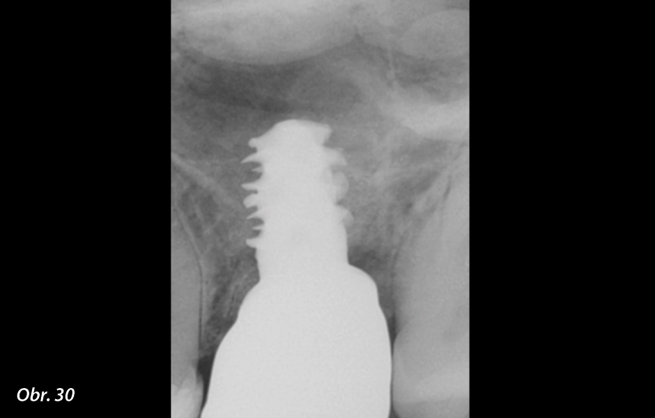 Straumann® TLX implantát a okamžitá náhrada jednoho moláru v horní čelisti